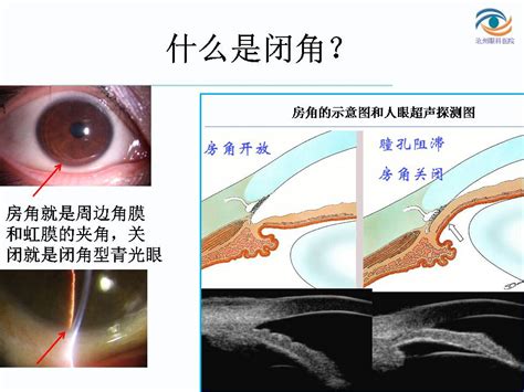 房角|原发性开角型青光眼